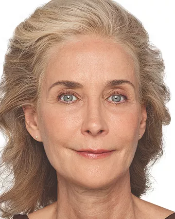 Headshot Cheryl - Juvederm  Customise After 2