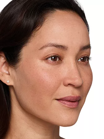 Headshot Cherub- Juvederm Customise After 2