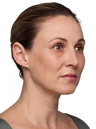 Headshot Kate - Juvederm Before