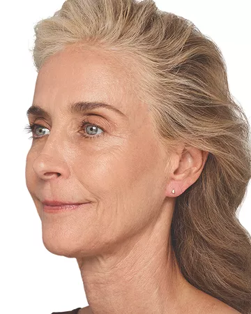 Headshot Cheryl - Juvederm  After 1