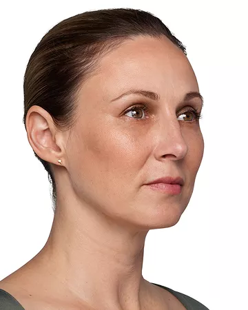 Headshot Kate - Juvederm After 1