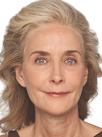 Headshot Cheryl - Juvederm  Customise After 2