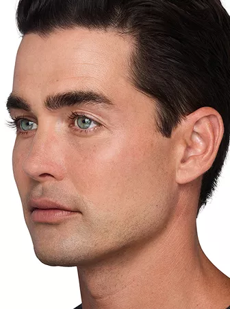 Headshot Sterling- Juvederm Customise After 2