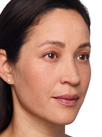 Headshot Cherub - Juvederm Before