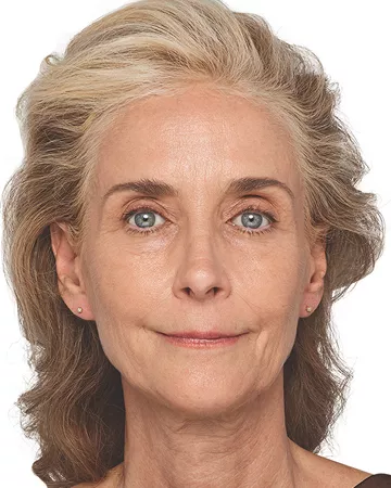 Headshot Cheryl - Juvederm Before