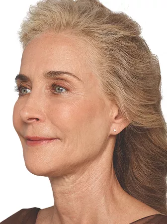 Headshot Cheryl - Juvederm  Optimise After 1