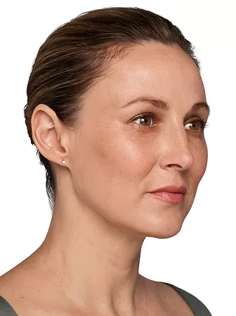 Headshot Kate - Juvederm Optimise After 2