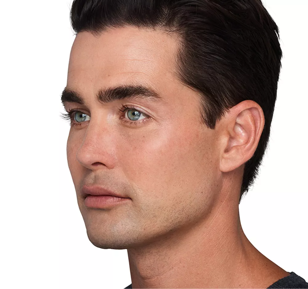 Headshot Sterling- Juvederm Customise After 2