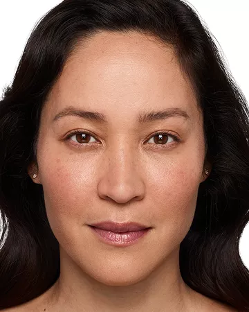 Headshot Cherub - Juvederm syringe in the cheeks After 1