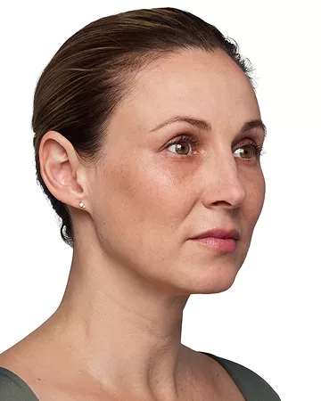 Headshot Kate - Juvederm Before