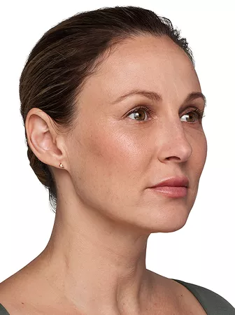 Headshot Kate - Juvederm Customise After 3