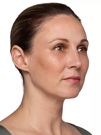 Headshot Kate - Juvederm After 1