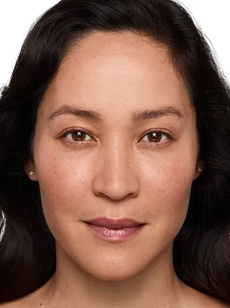 Headshot Cherub - Juvederm syringe in the cheeks After 1