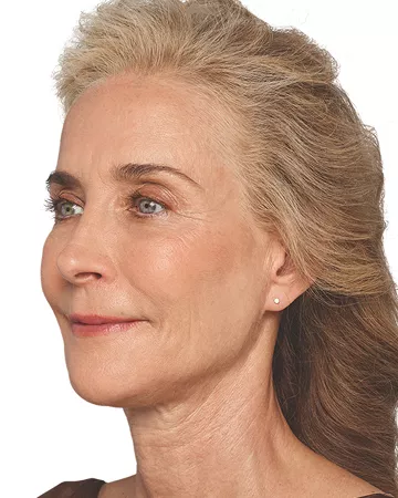 Headshot Cheryl - Juvederm  Optimise After 1