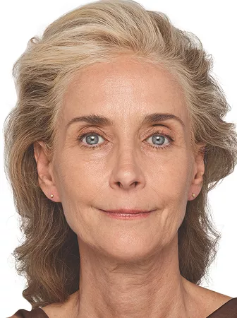 Headshot Cheryl - Juvederm Before