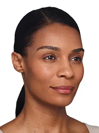 Headshot Kristin- Juvederm Optimise After 3