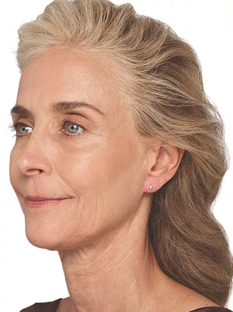 Headshot Cheryl - Juvederm  After 1