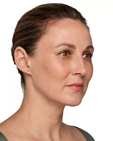 Headshot Kate - Juvederm Optimise After 2