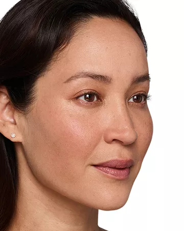 Headshot Cherub- Juvederm Customise After 2