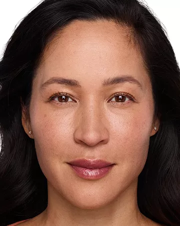 Headshot Cherub- Juvederm Optimise After 3