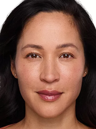 Headshot Cherub- Juvederm Optimise After 3