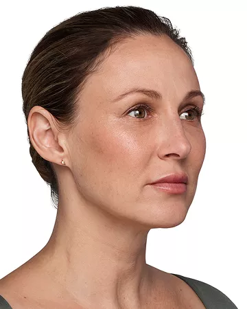 Headshot Kate - Juvederm Customise After 3